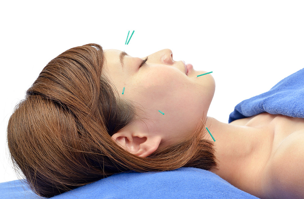 美顔はり（美容鍼）